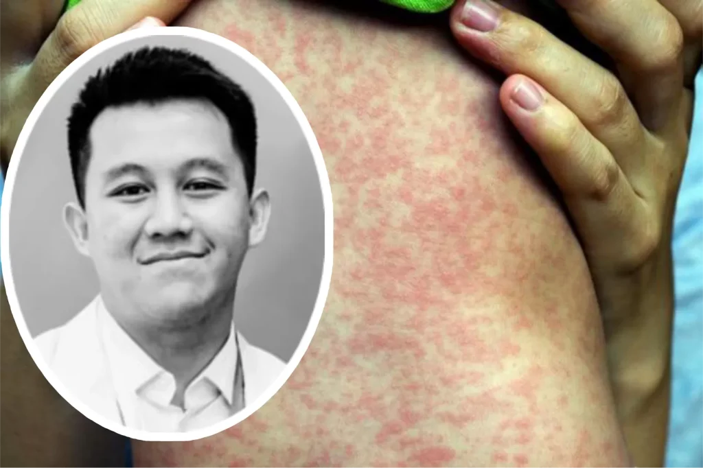 Dokter Meninggal karena Campak